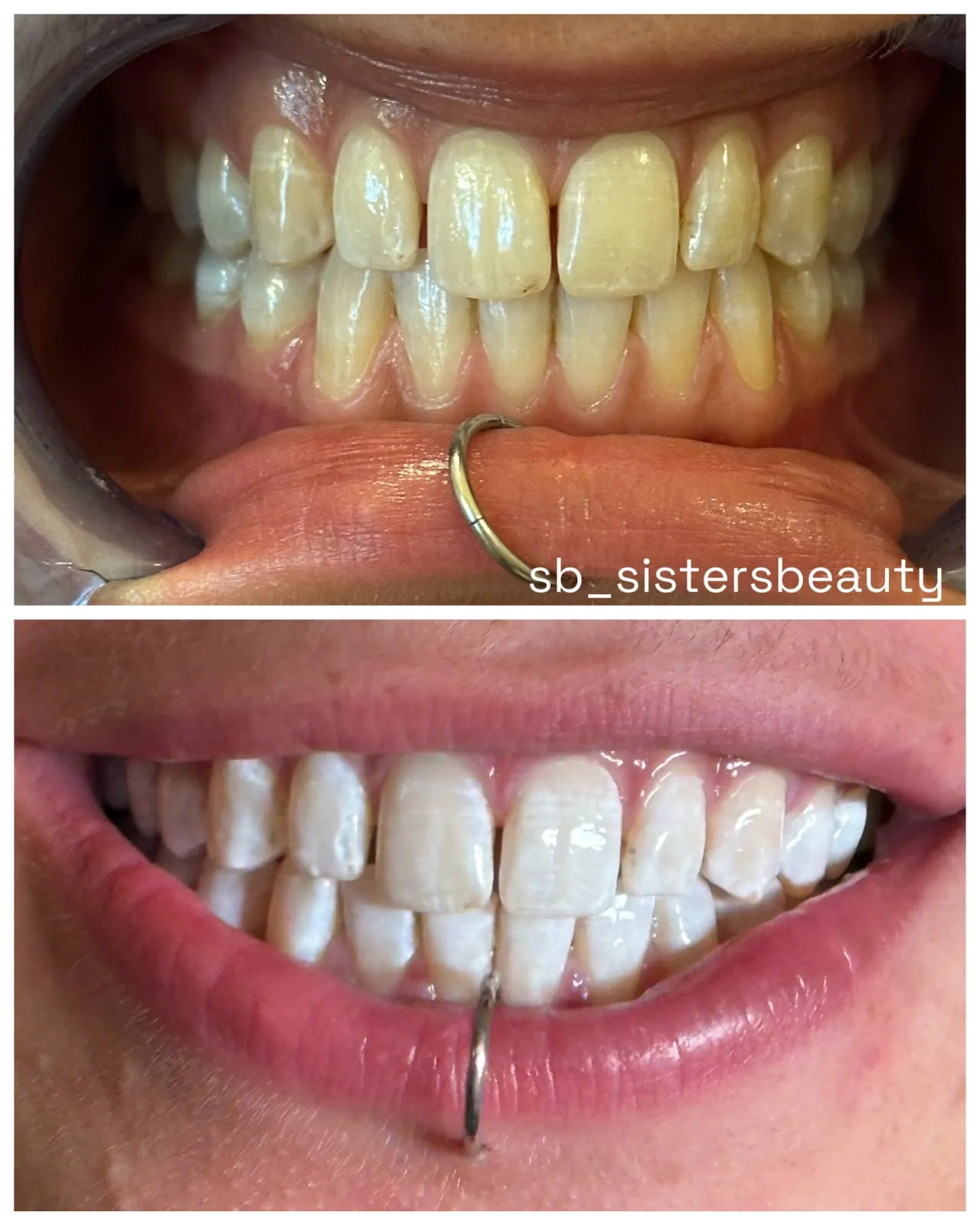 Echtes Vorher-Nachher-Ergebnis einer kosmetischen Zahnaufhellung bei SB Sisters Beauty.